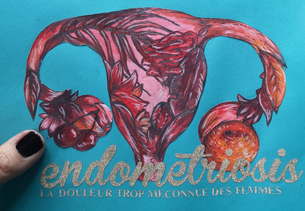 Endometriose illustration 